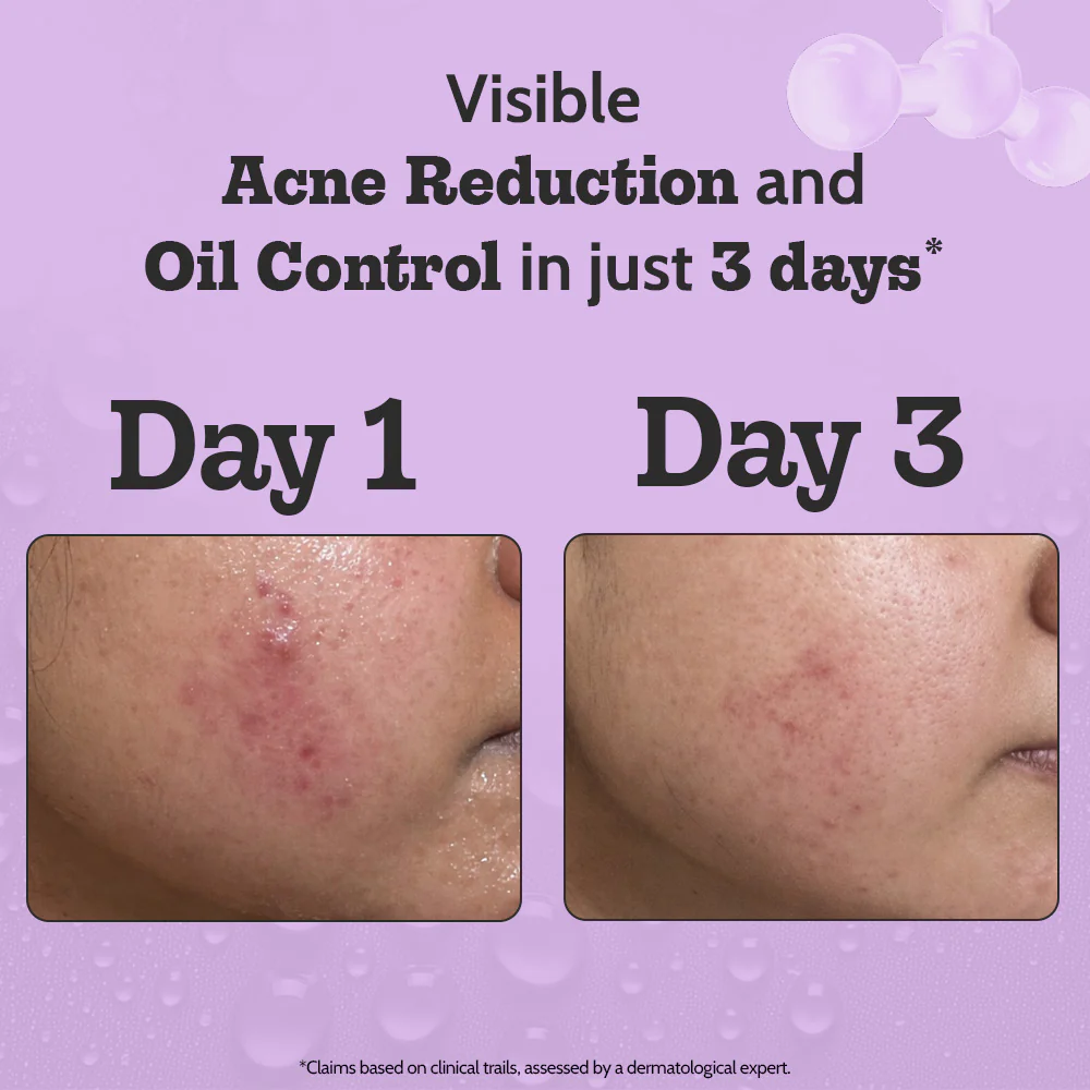 2% Salicylic Acid Face Serum for Acne Control - 30 ml - Image 3