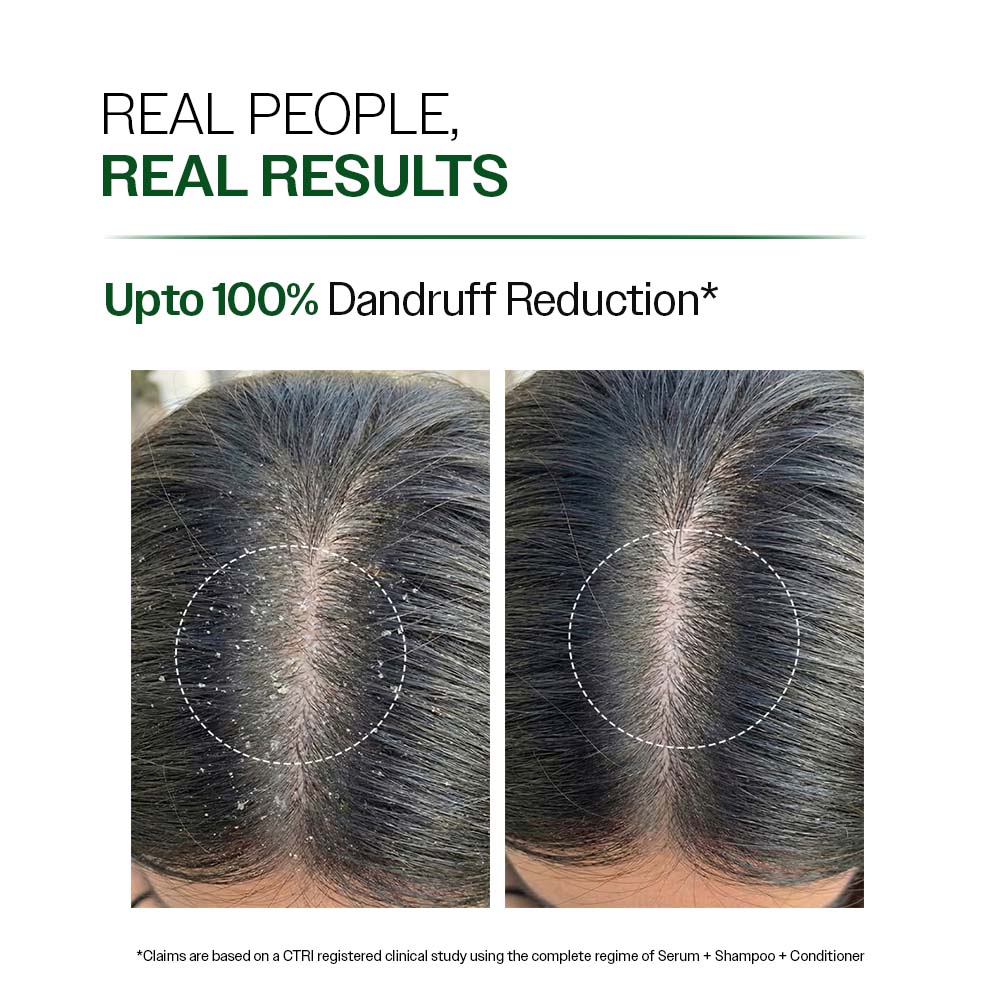 Anti Dandruff Shampoo with Salicylic Acid, Piroctone Olamine & Biotin - 100 ml - Image 3