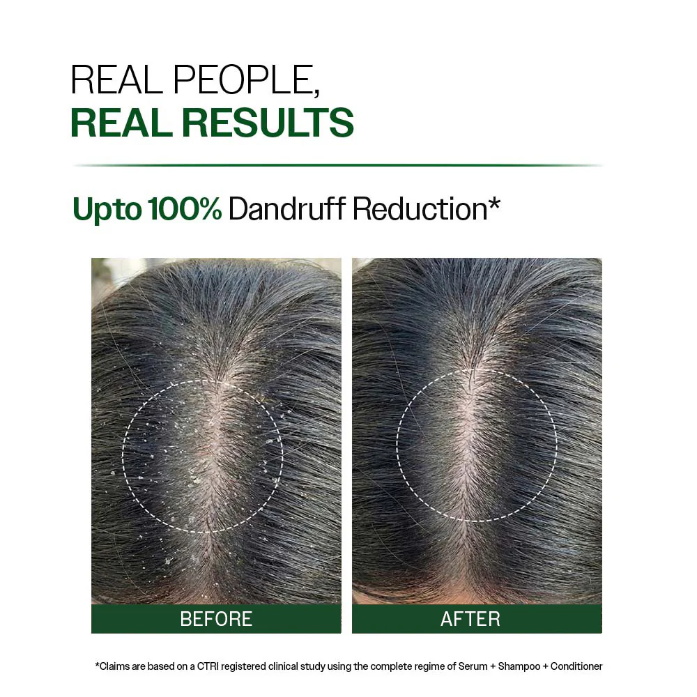 Anti Dandruff Shampoo with Salicylic Acid, Piroctone Olamine & Biotin - 250ml - Image 3